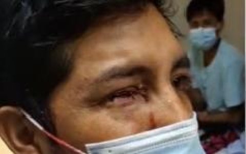 Así quedó la cavidad ocular del afectado, tras la cirugía de riesgo.