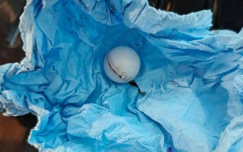 Evidencia del perdigón que los galenos encontraron en lugar del ojo.