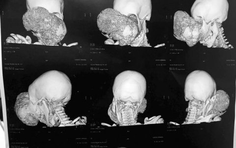 TAC con distintas imágenes del tumor.