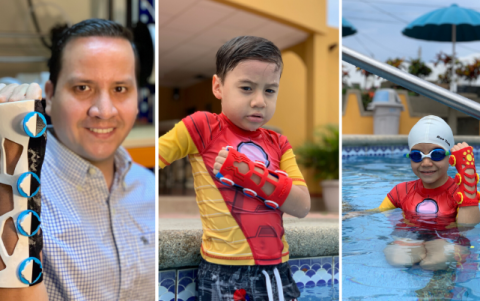 La férulas 3D de Gabriel le dicen adiós al yeso, son personalizadas y resistentes al agua.