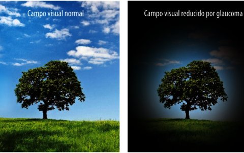 Esta es la forma en que afecta el glaucoma a la visión.