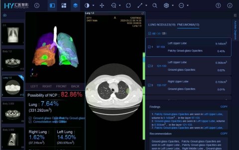 El nuevo sistema de Huawei tiene la capacidad de ofrecer un diagnostico sobre un posible caso de coronavirus en el lapso de 1 minuto.