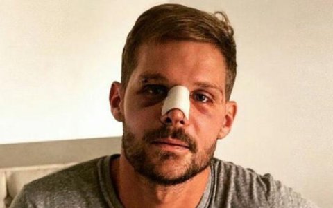 Javier Burrai, al poco tiempo de ser operado de la fractura nasal.