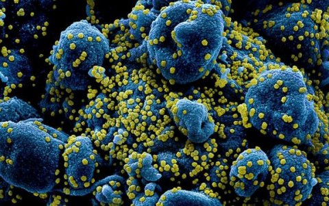 Partículas del virus SARS-COV-2 o coronavirus (en amarillo) infectando células (azuladas) aisladas de un paciente y vistas a través de un microscopio electrónico./ NIAID