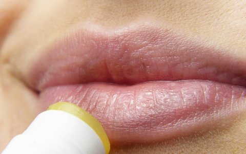 El herpes labial causa síntomas como picor y ardor.
