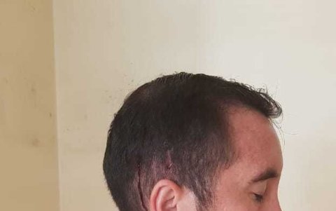 Daño. Rafael Ochoa recibió una pedrada en su cabeza.