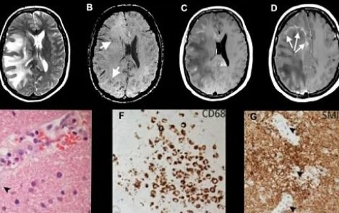 Imagen del cerebro de uno de los pacientes del estudio.