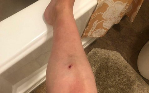 Ambas extremidades están inflamadas.