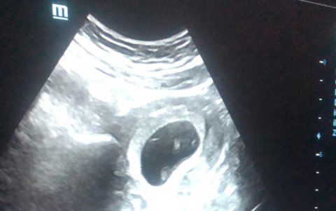 Ecografía del bebé.
