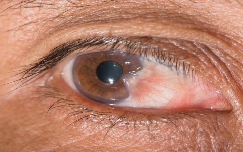 Esta patología se presenta más en hombres que en mujeres, debido a varios factores.