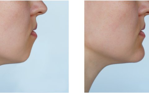 Antes y después de la mentoplastia.