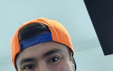 Luego de la cirugía de papada.