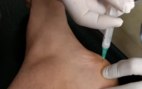 Las inflitraciones con esteroides ayudan a menguar el dolor del talón