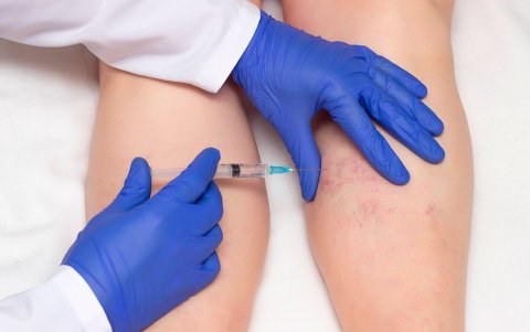 La escleroterapia es un tratamiento mínimamente invasivo, ideal para las venas varicosas pequeñas.