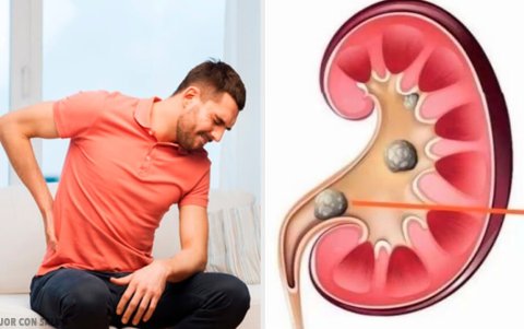 El tratamiento depende del tamaño de la piedra y su  ubicación