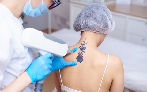 El láser ayuda a eliminar tatuajes.