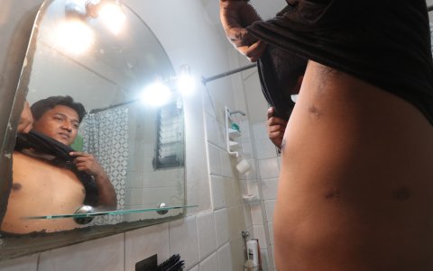 Tres cicatrices de los 10 balazos que ha recibido el guardia.