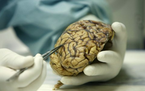 Un científico observa un cerebro humano enfermo de alzheimer, en una foto de archivo.