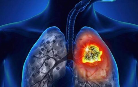 Además de fumar, las enfermedades crónicas como la tuberculosis y las exposiciones a metales como el plomo o el cadmio son factores de riesgo para desarrollar cáncer de pulmón