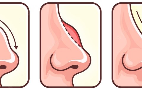 El antes y después de una rinoplastia.