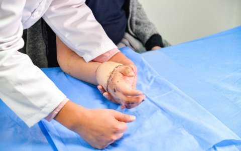 Resultado. Se aprecia cómo quedó la mano después de haberla unido al brazo con cuatro clavos.