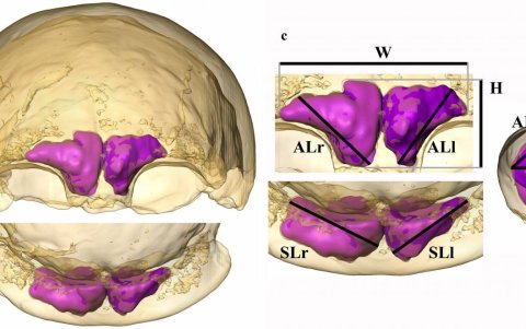 Visualización y cuantificación de los senos frontales. /