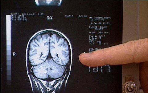 Científicos logran que la quimioterapia traspase el escudo protector del cerebro.