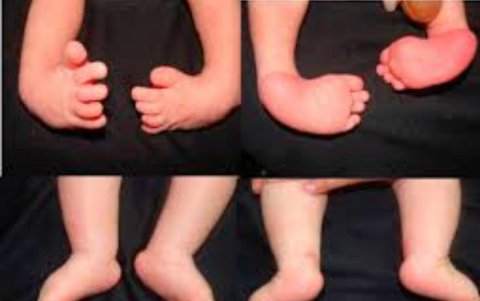 Las cirugías de pie equinovaro se desarrollarán entre el 25 y 29 de septiembre.