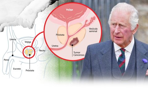 El cáncer de próstata es uno de los más comunes en Reino Unido.
