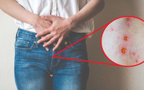 Dolor y ardo al orinar son algunos de los síntomas de contagio.r