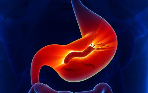 La patogenia de Helicobacter pylori es compleja y multifactorial porque involucra defensas gástricas