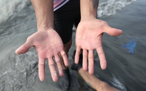 Las ampollas de uno de los remeros.