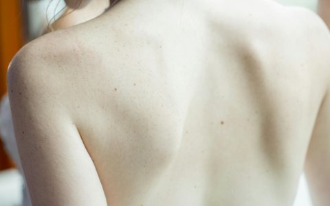 Una de las causas del síndrome de Cushing puede ser un tumor en la glándulas suprarrenales.