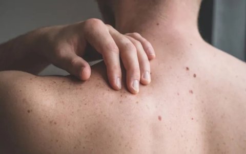 El melanoma es el cáncer de piel más agresivo.