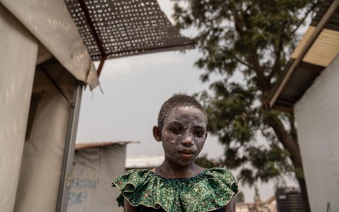 El mpox pertenece a la misma familia de virus que la viruela, pero causa síntomas más leves como fiebre, escalofríos y dolores corporales. EFE/EPA/MOISE KASEREKA