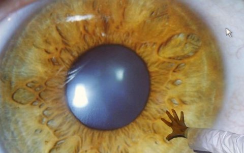 El ojo seco está asociado con la infección de un parásito que forma parte de la microbiota ocular.