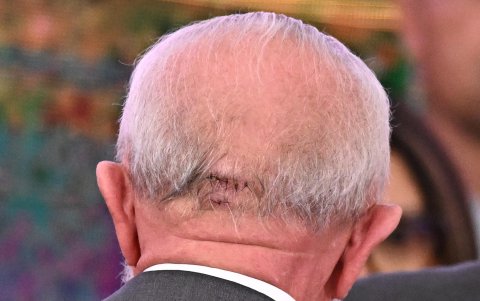 Foto del 25 de octubre de 2024 de la lesión en la cabeza del presidente de Brasil, Luiz Inácio Lula da Silva.