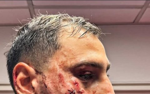 El rostro de Gianluigi Donnarumma luego de ser intervenido por los médicos del PSG