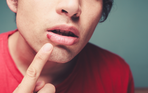 Besar a un niño con herpes labial activo puede poner en riesgo su salud ocular y general.