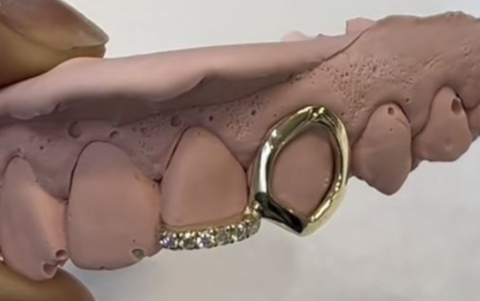 Los grillz temporales pueden dañar el esmalte natural de los dientes.