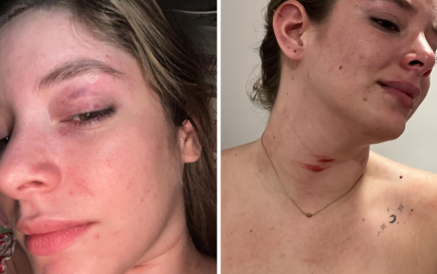 Nicolle Aray compartió en Instagram las evidencias del maltrato que sufrió la madrugada del sábado.