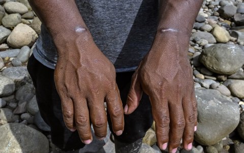 Un agricultor muestra las lesiones en sus muñecas, que según él fueron causadas por las ataduras utilizadas para inmovilizarlo durante una operación antidrogas del ejército ecuatoriano.