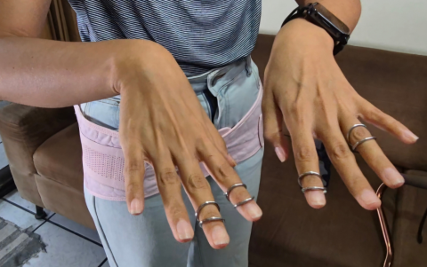 El uso de anillos correctivos se convierte en una medida necesaria para proteger la movilidad de los dedos y evitar luxaciones.”