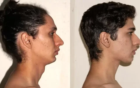 El 'mewing' es una técnica de posicionamiento de la lengua que promete ayudar a definir la línea de la mandíbula.