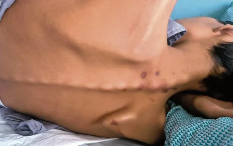 Secuelas. La desnutrición crónica ha deteriorado notablemente el estado físico de Cristhian.