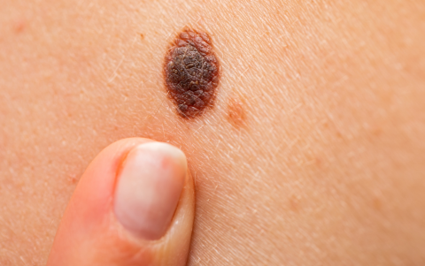 El tratamiento busca ayudar al sistema inmunitario a reconocer y atacar las células cancerosas.