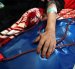 Detalle del brazo de una mujer mientras se somete a un proceso de diálisis.