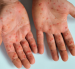 Erupciones o lesiones cutáneas aparecen en la cara, las palmas de las manos y las plantas de los pies en casos de viruela símica o mpox.