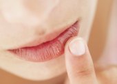 Herpes en la comisura de los labios