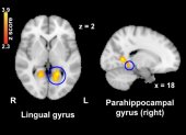 La activación cerebral en el giro lingual y en el giro parahipocampal, áreas involucradas en la percepción del dolor, disminuyó significativamente después de ver imágenes nostálgicas en comparación con las imágenes de control.